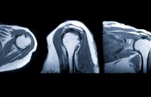 Resonancia magn&eacute;tica abierta de hombro en DMI SALUD