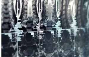 Resonancia magn&eacute;tica abierta de cadera
